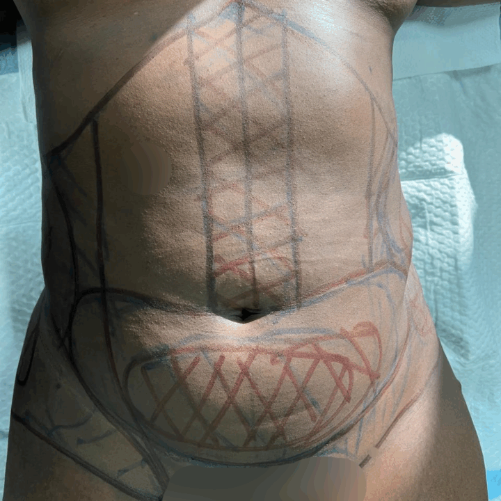 Before Frontal Liposuction