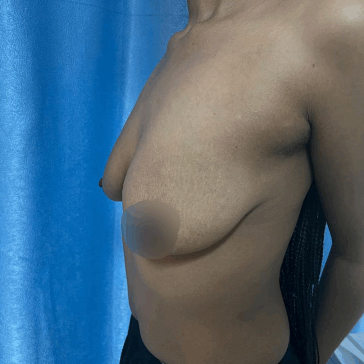 Augmentation Mammoplasty