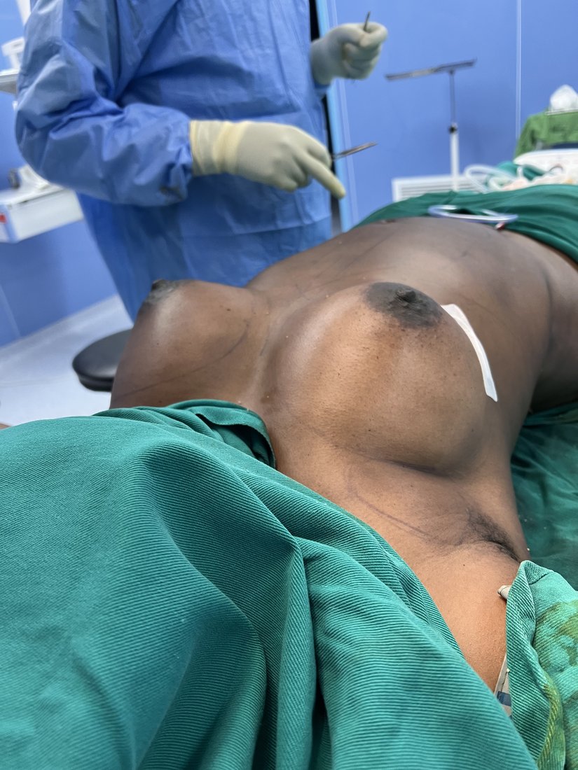Breast augmentation photo 1