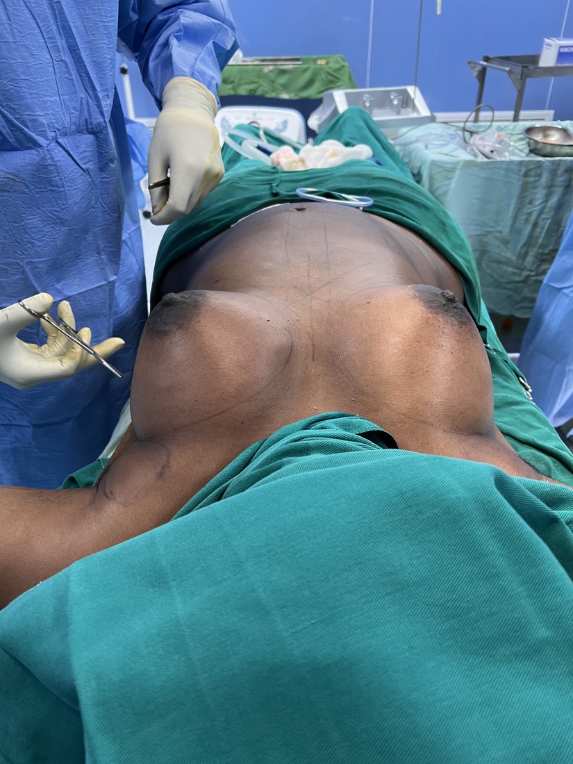 Breast augmentation photo 9