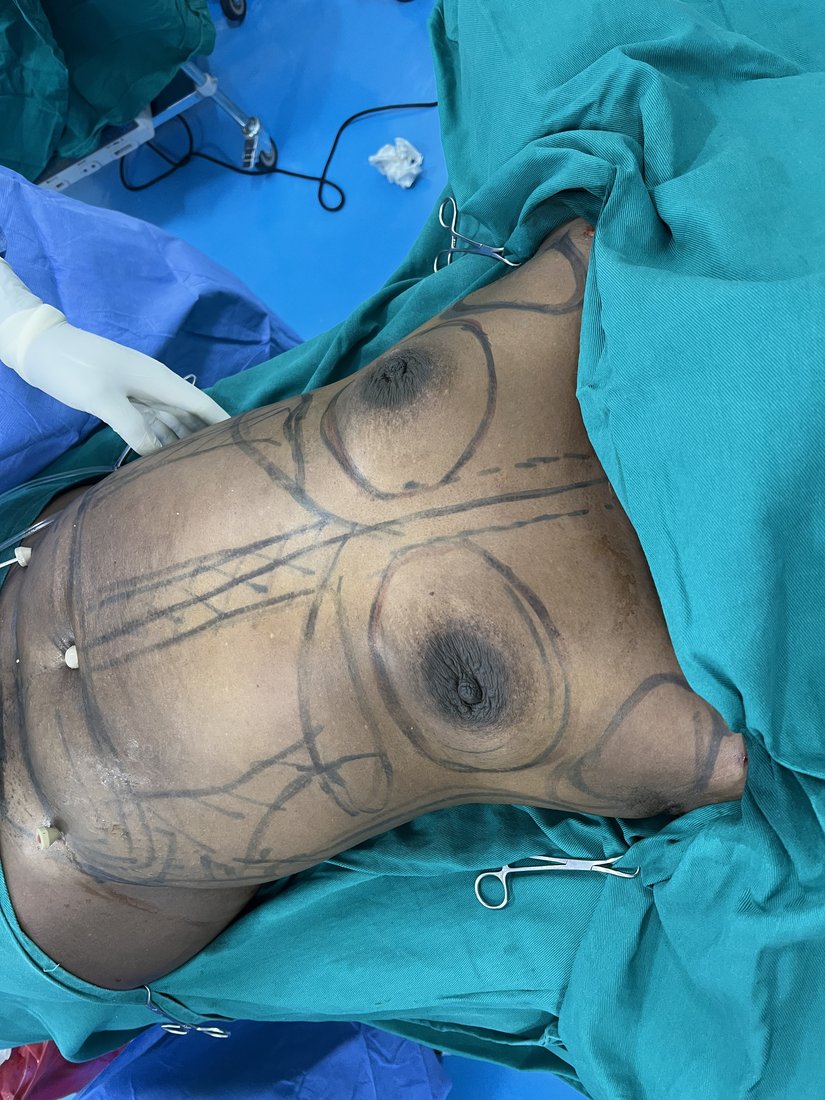 Breast augmentation photo 16