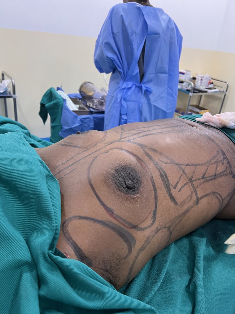 Breast augmentation photo 17