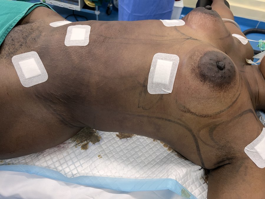 Breast augmentation photo 20