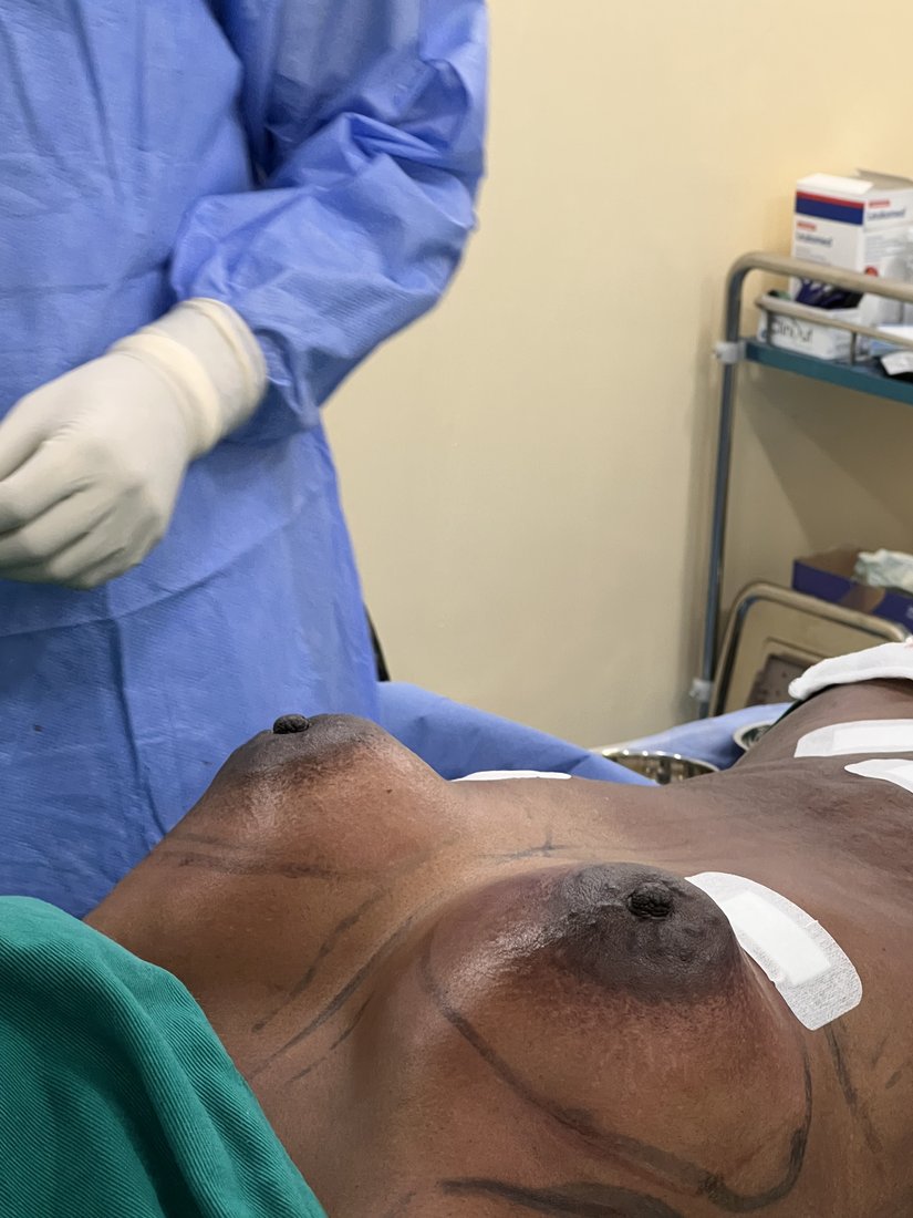 Breast augmentation photo 24