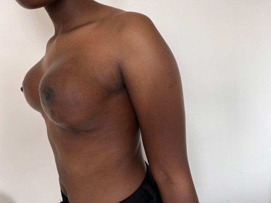 Breast augmentation photo 28