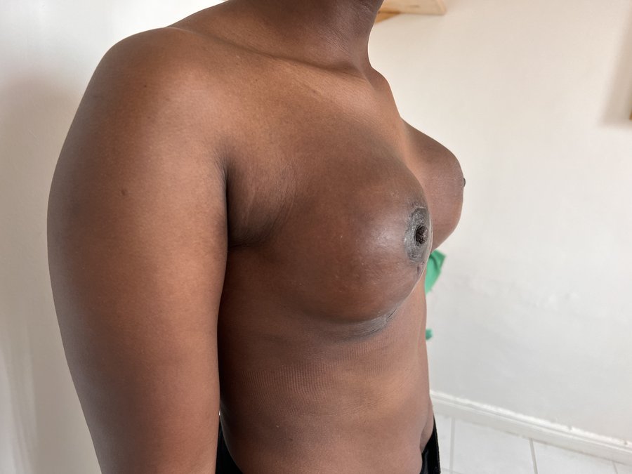 Breast augmentation photo 30