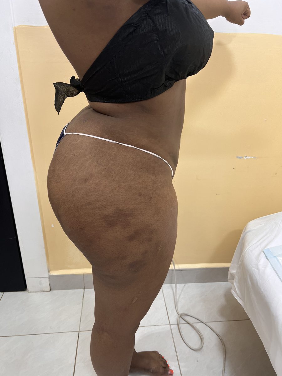 Brazilian Butt Lift photo 3