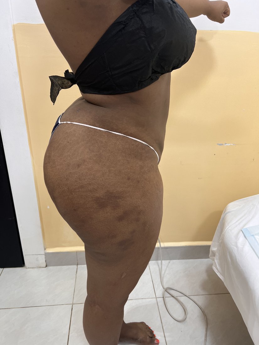 Brazilian Butt Lift photo 9