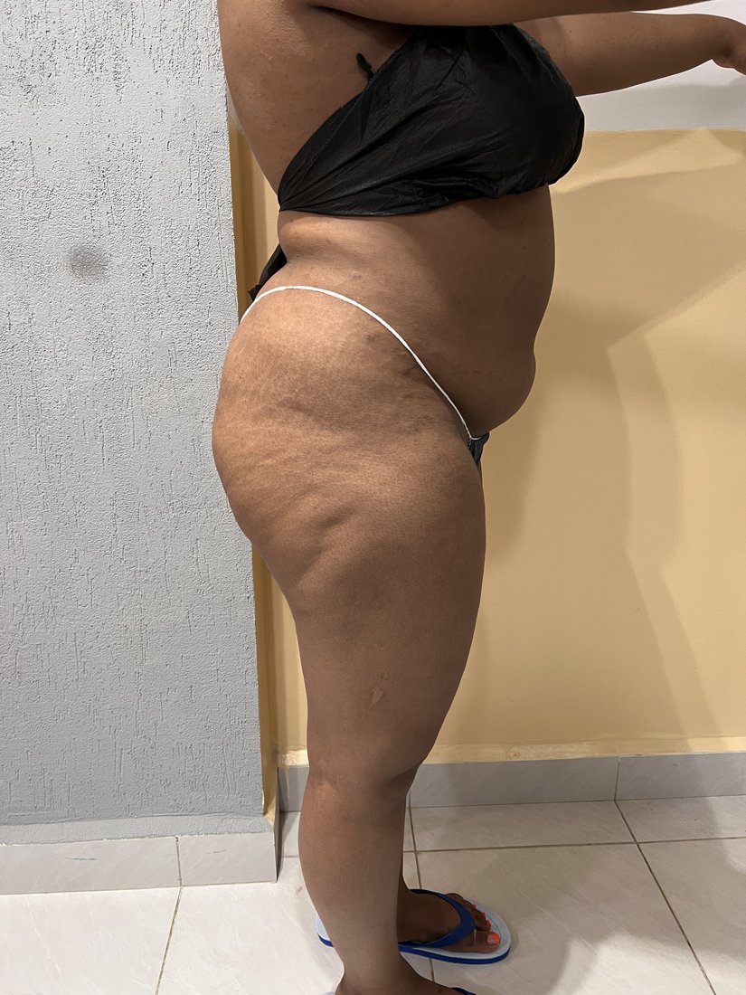 Brazilian Butt Lift photo 10