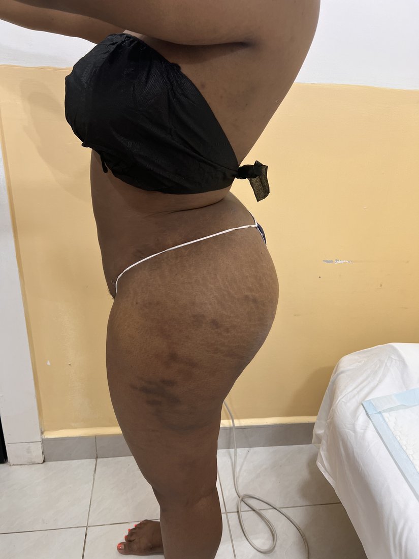 Brazilian Butt Lift photo 16