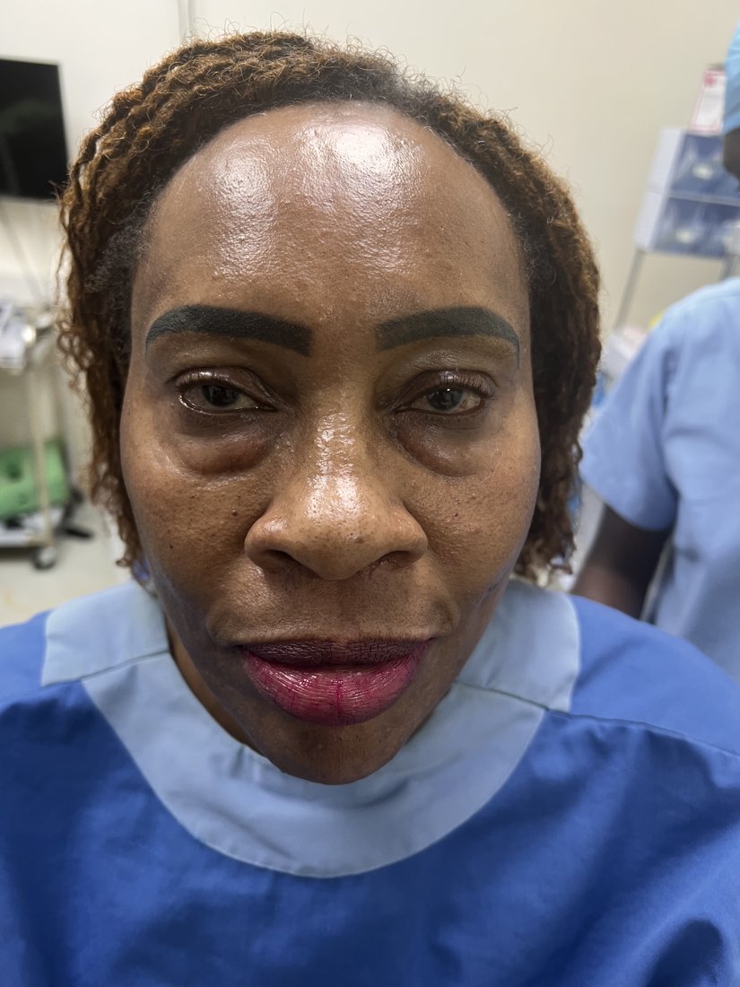 Blepharoplasty photo 3