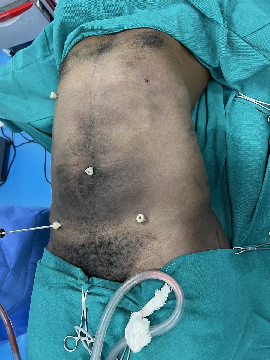 Liposuction photo 2