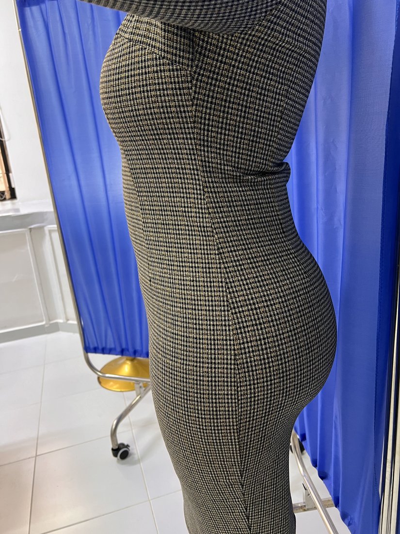 Liposuction photo 5