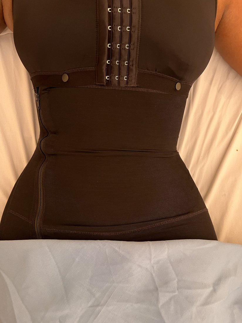 Liposuction photo 6