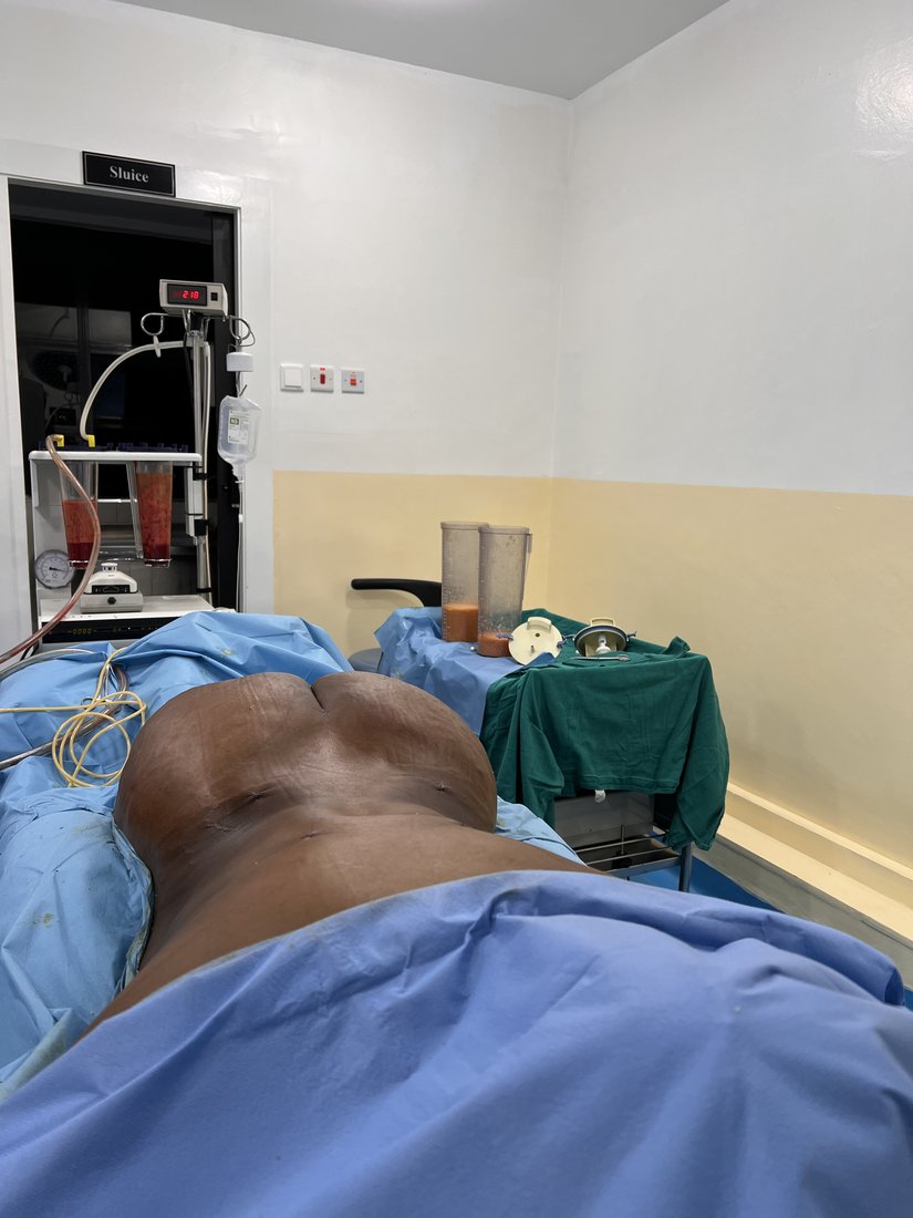 Liposuction photo 14