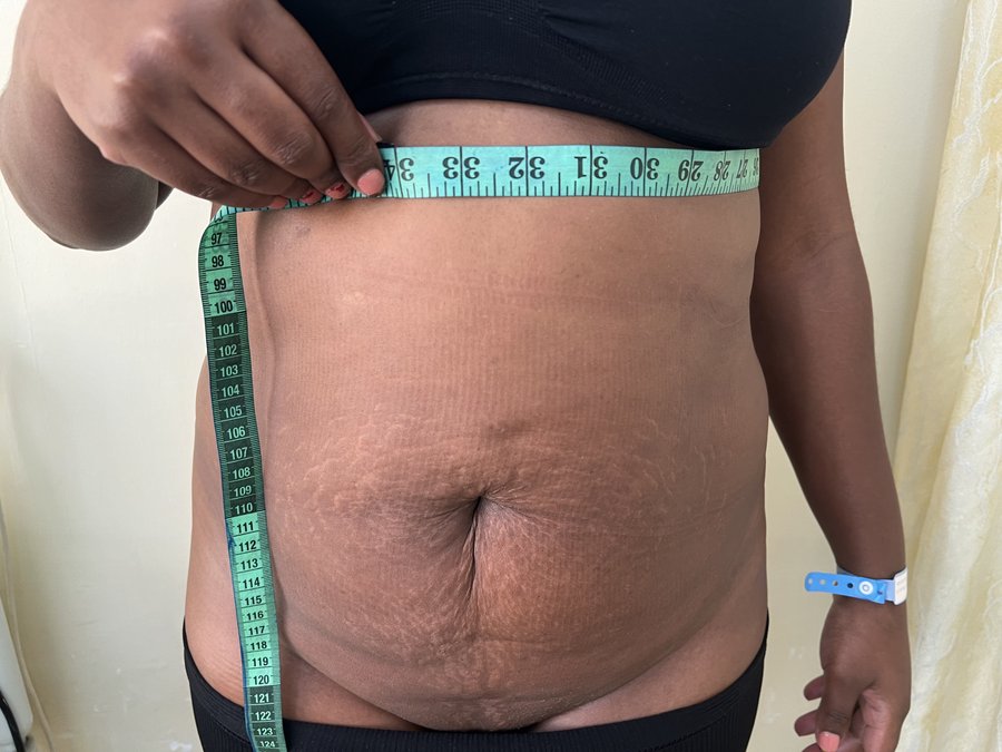 Liposuction photo 16