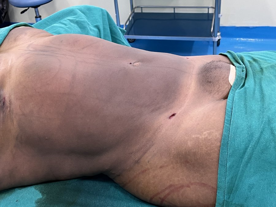 Liposuction photo 19