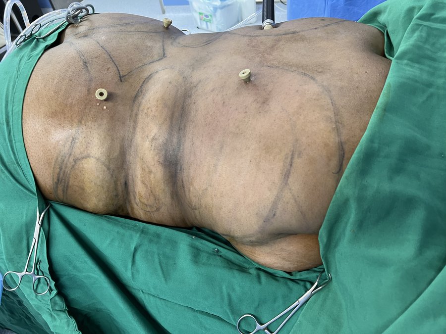 Liposuction photo 20
