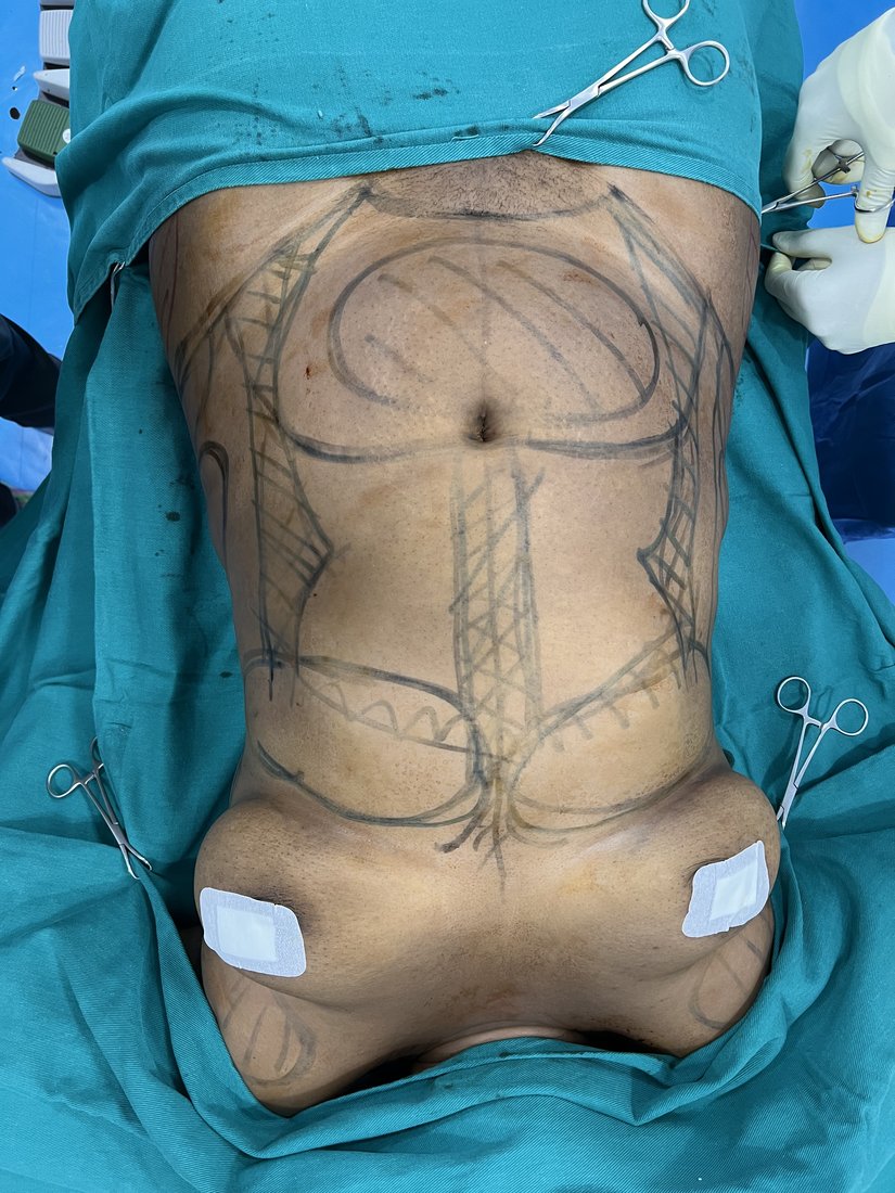 Liposuction photo 21