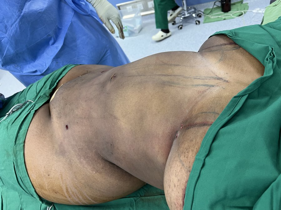 Liposuction photo 26