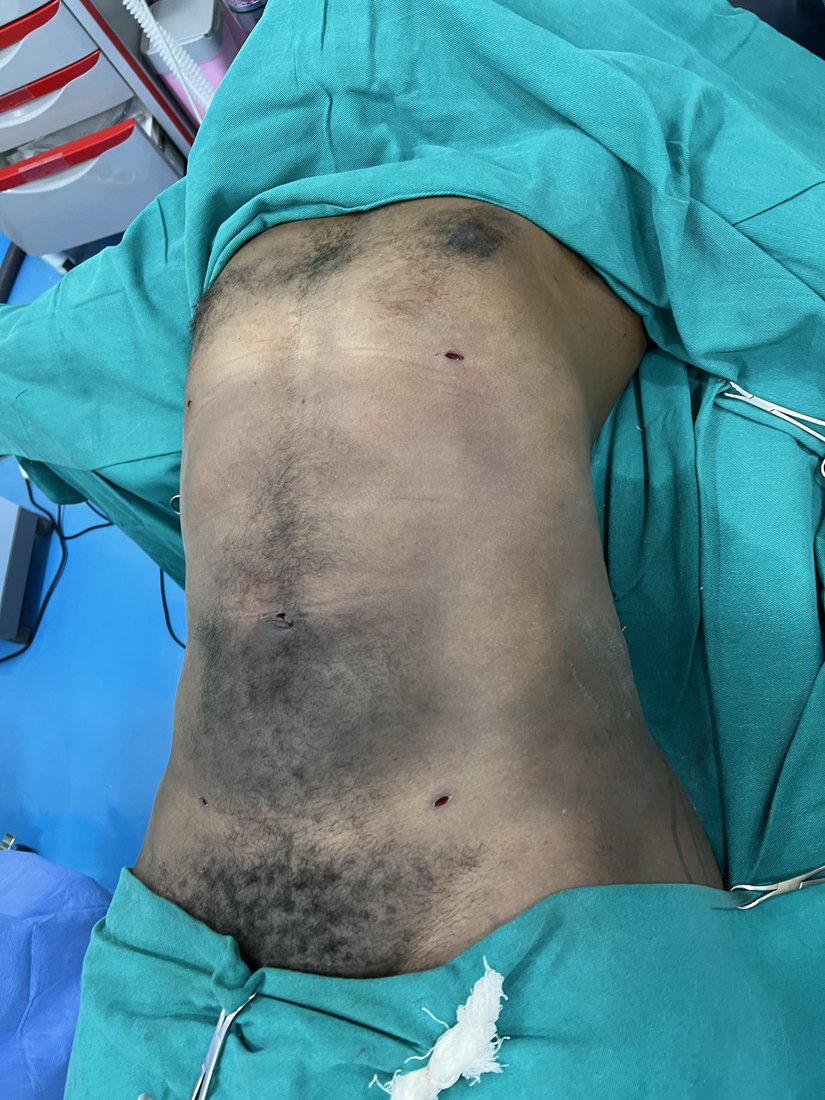 Liposuction photo 27