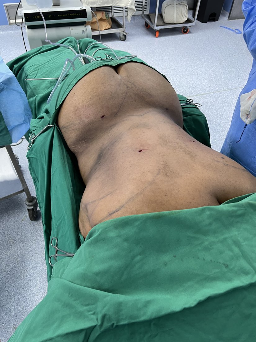 Liposuction photo 28