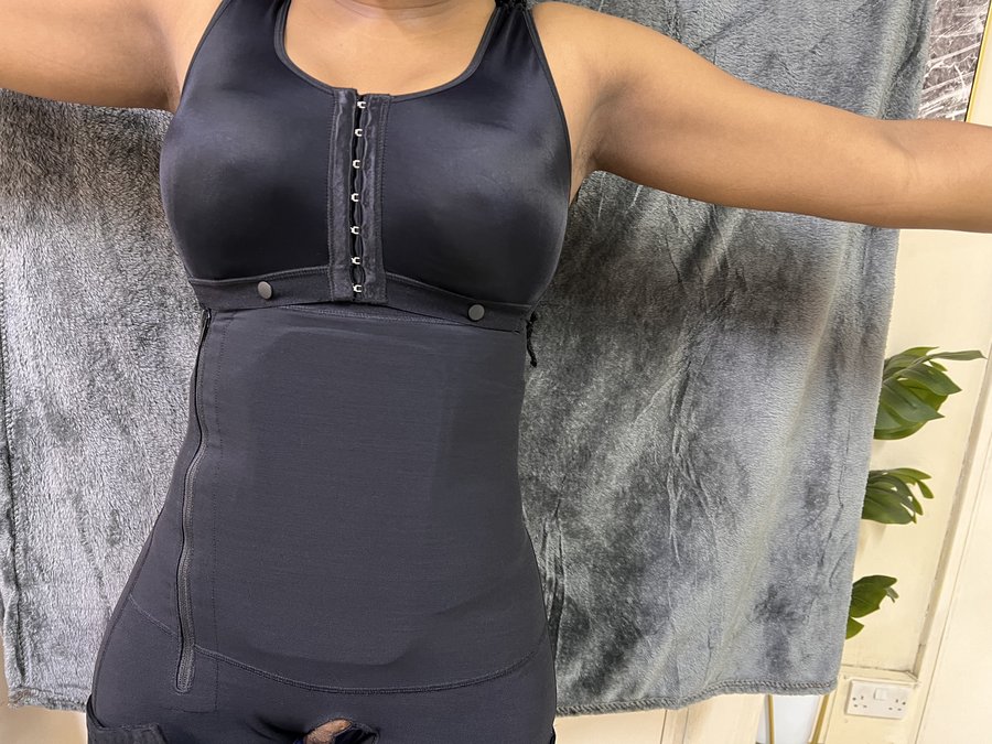 Liposuction photo 36