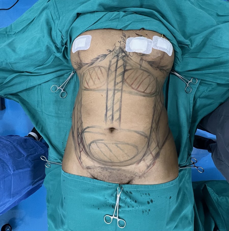 Liposuction photo 39