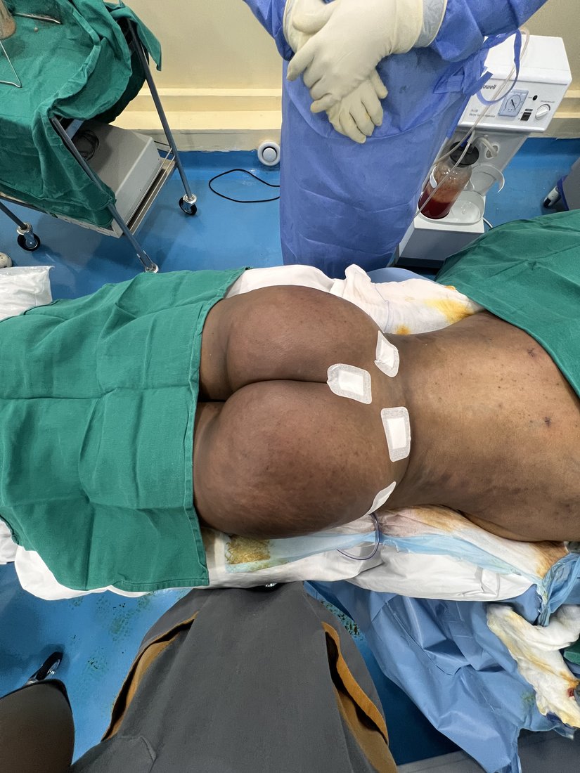 Liposuction photo 41