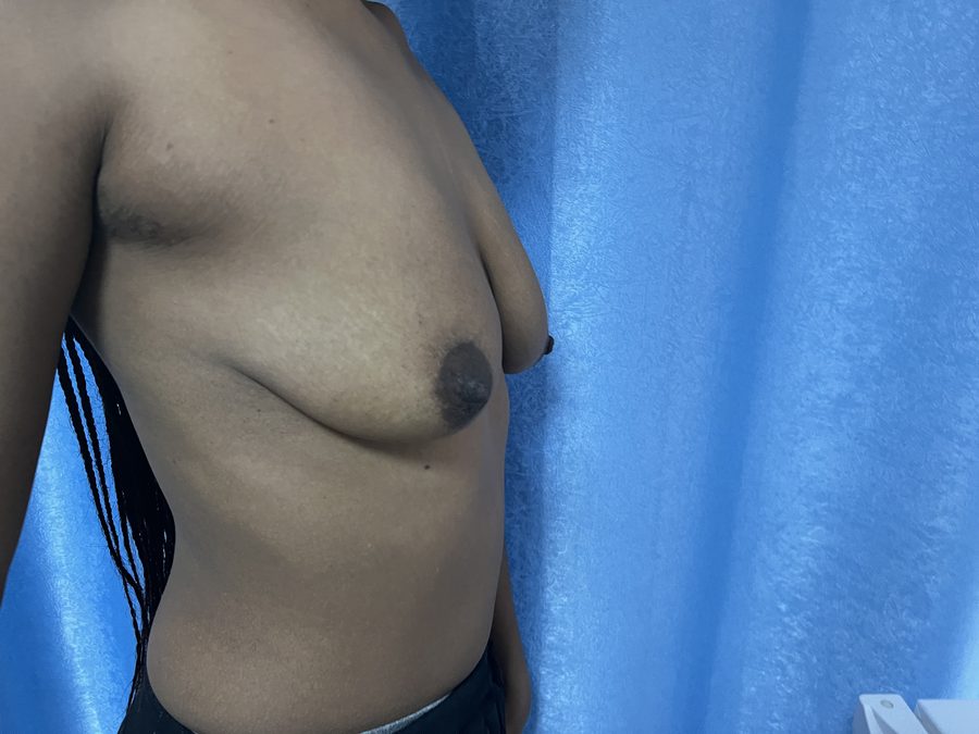 Mastopexy photo 2
