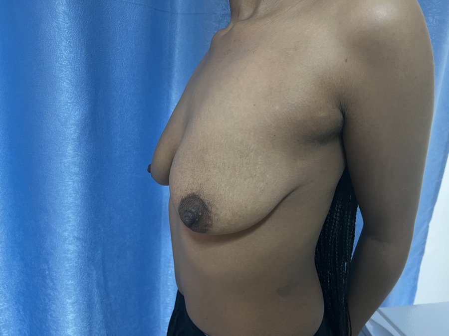 Mastopexy photo 5