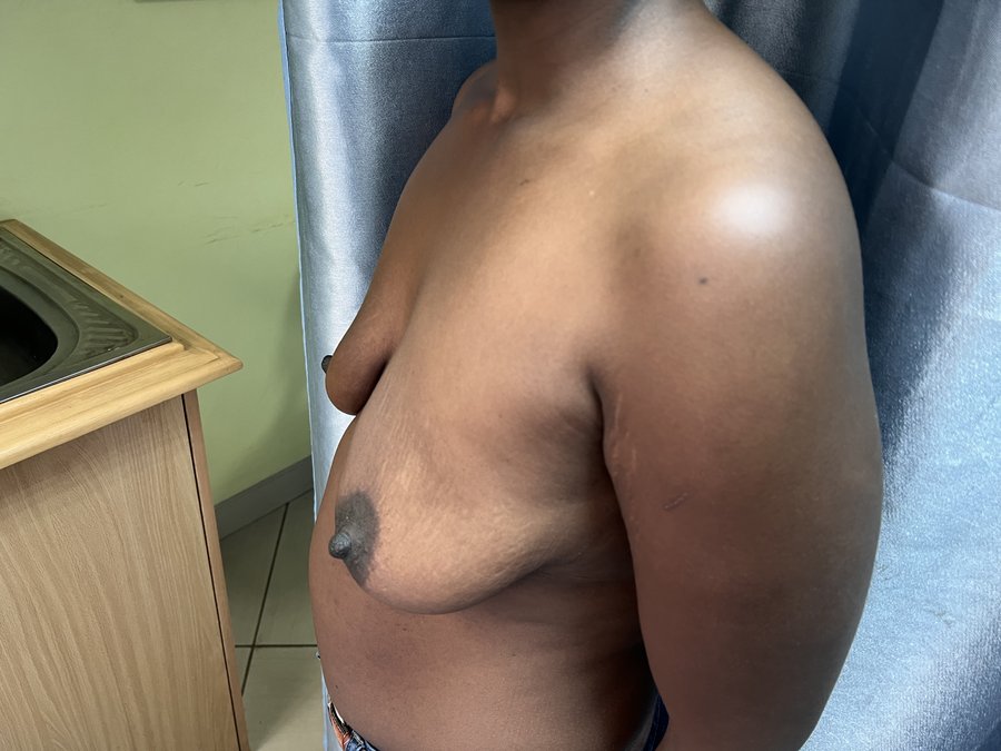 Mastopexy photo 13
