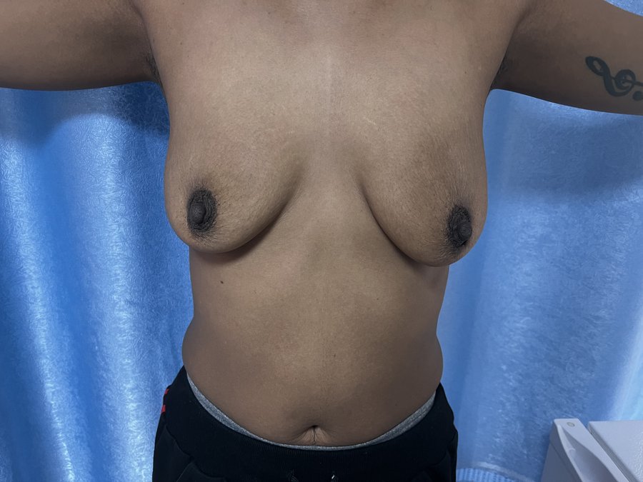 Mastopexy photo 19