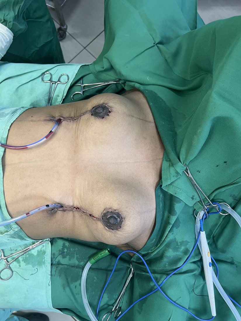 Mastopexy photo 20
