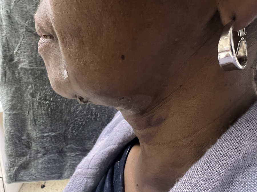 Neck lift photo 5