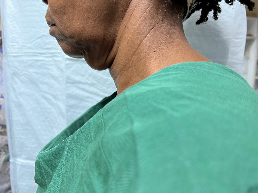 Neck lift photo 6