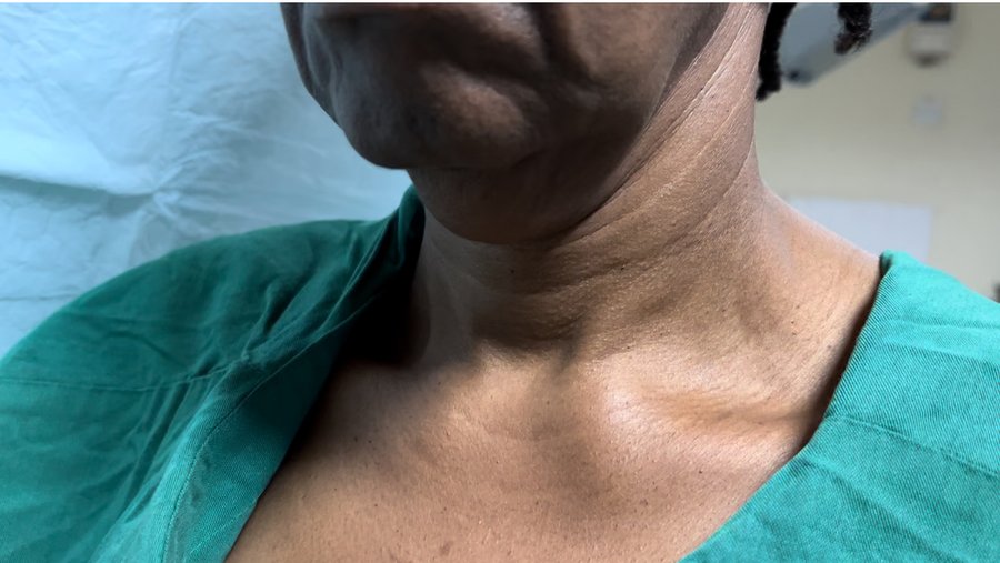 Neck lift photo 8