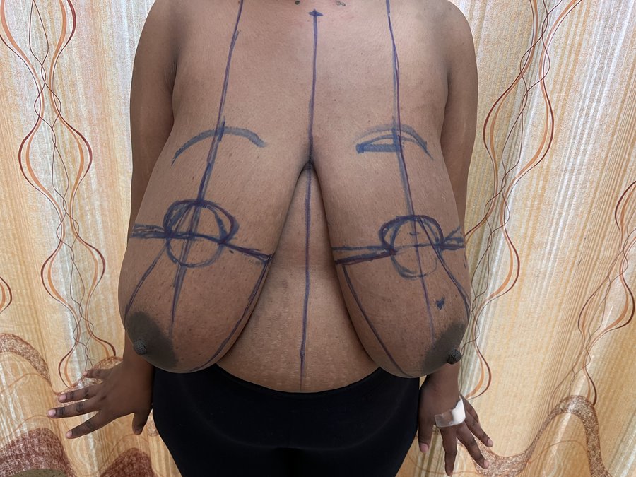 Breast reduction photo 13