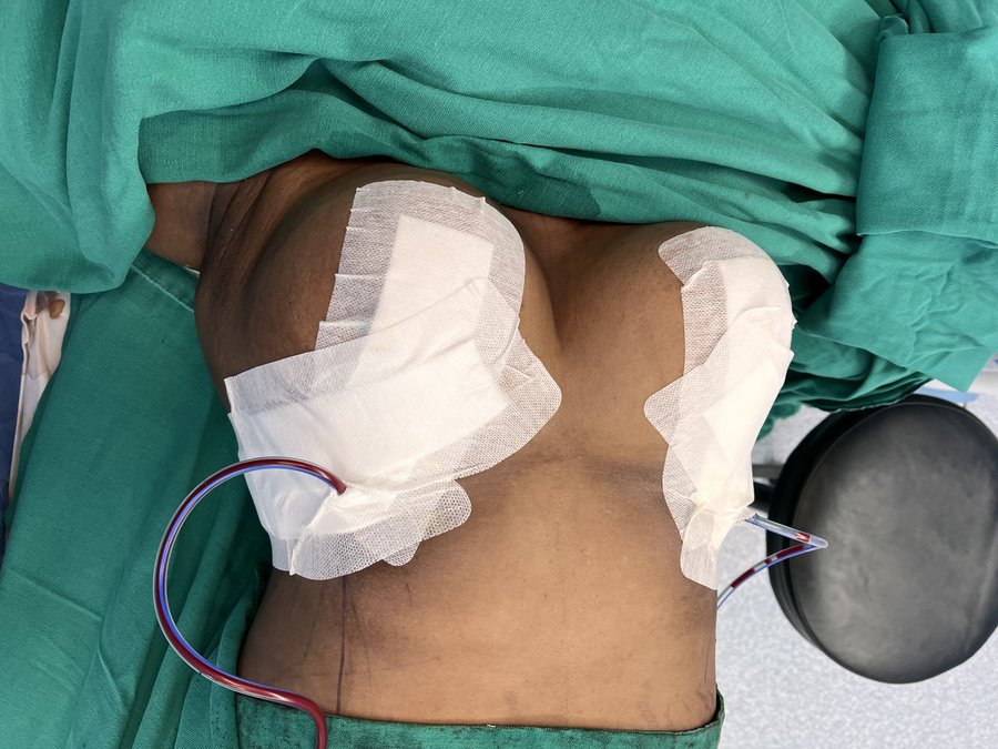 Breast reduction photo 19