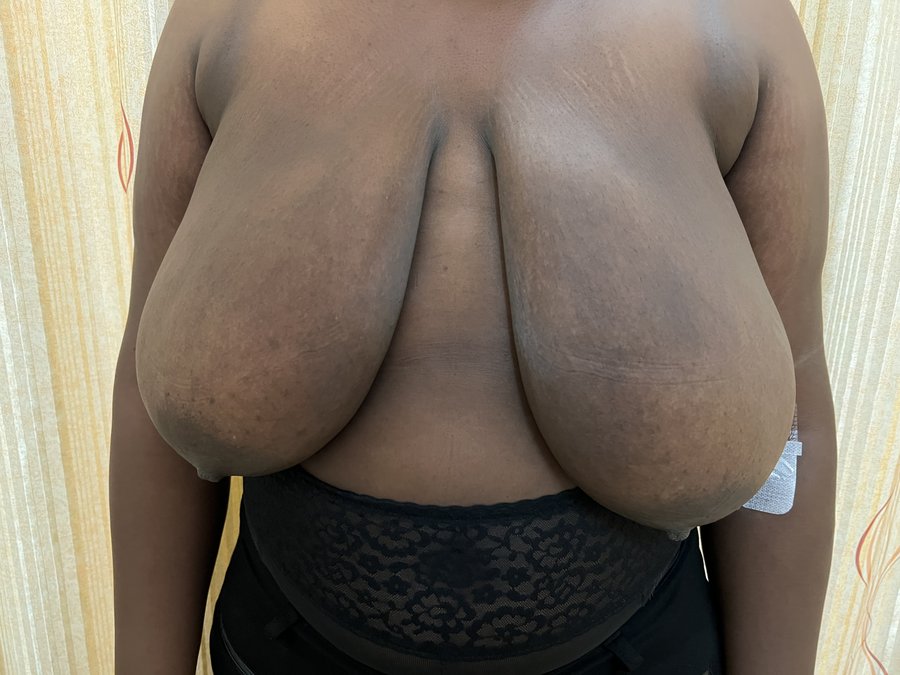 Breast reduction photo 20