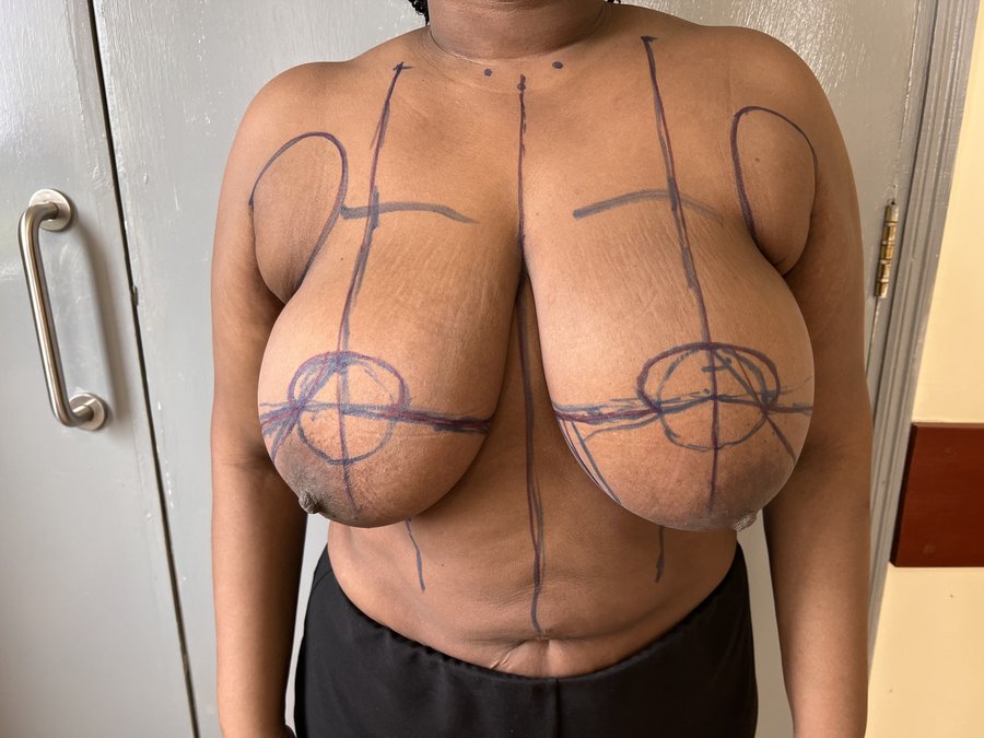 Breast reduction photo 21