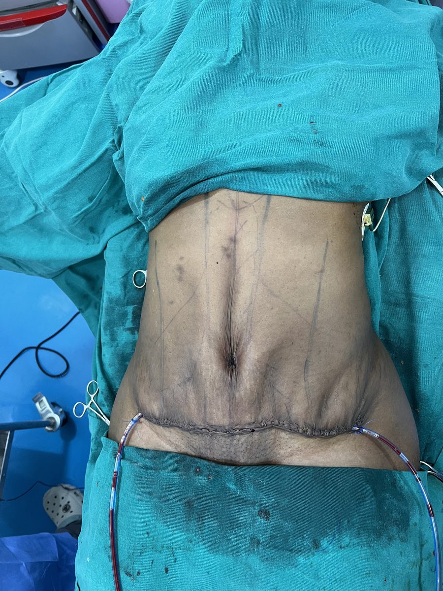 Tummy tuck photo 2