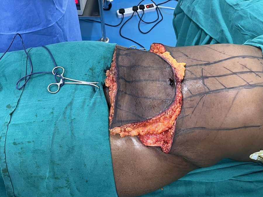 Tummy tuck photo 3