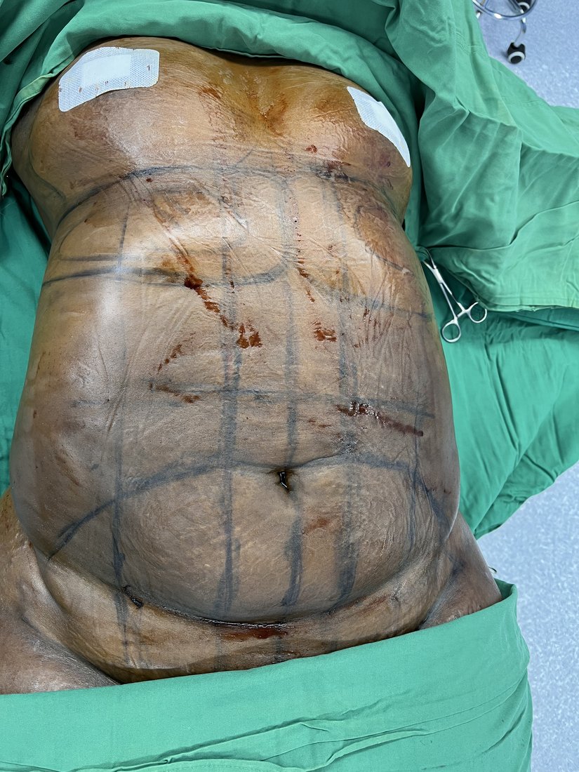 Tummy tuck photo 4