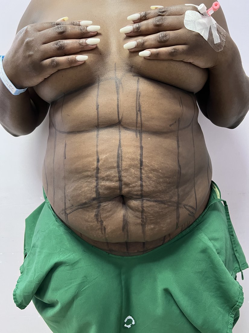 Tummy tuck photo 10
