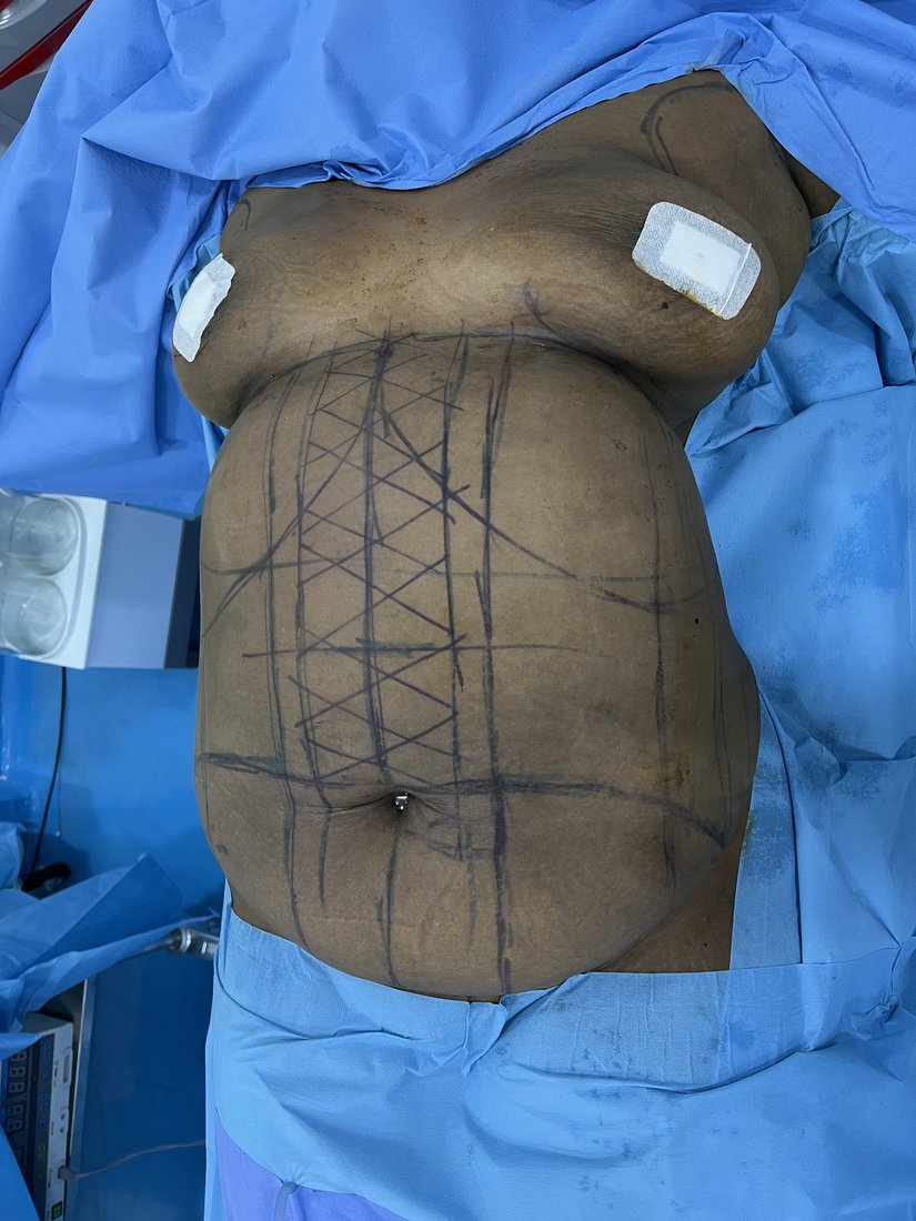 Tummy tuck photo 13