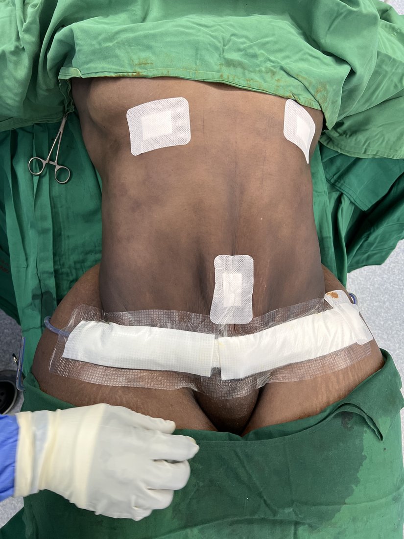 Tummy tuck photo 14