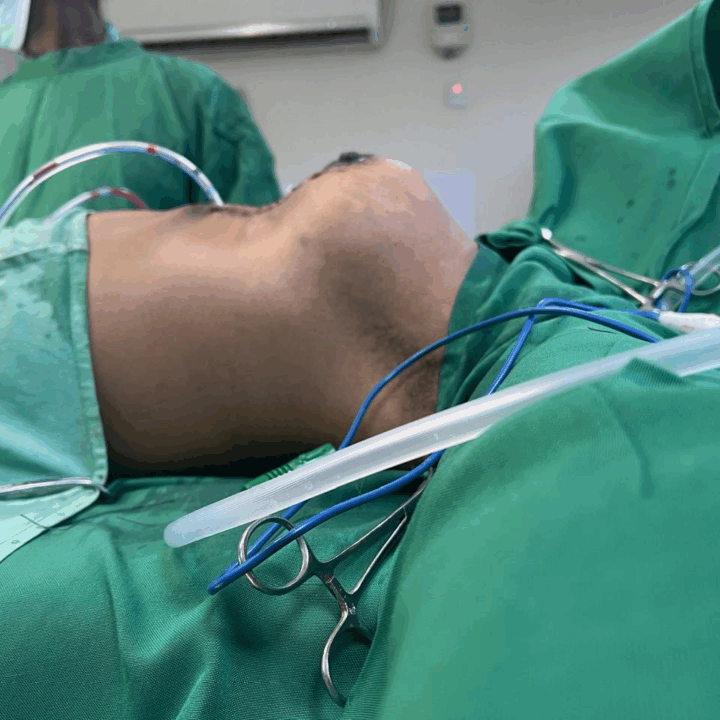 Mastopexy Breast Lift